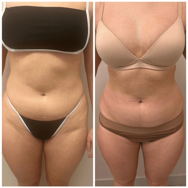 Face and body gym pack of 3 at Beauty Gym Aesthetics in Latham, NY